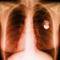 Square_pacemaker_xray-767691_1274312211